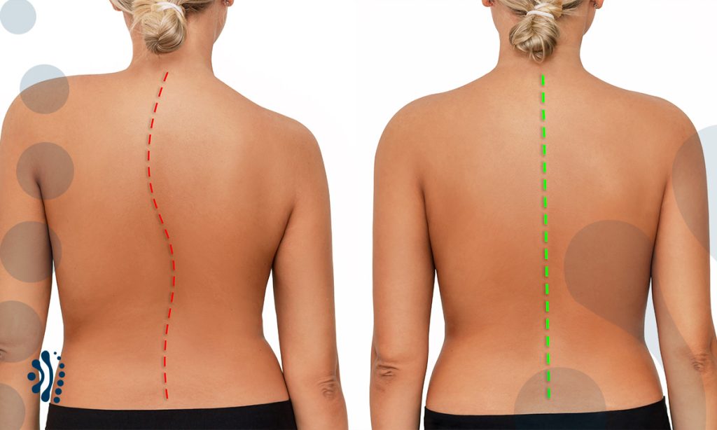 escoliose degenerativa dr eloy rusafa neurocirurgiao coluna vertebral