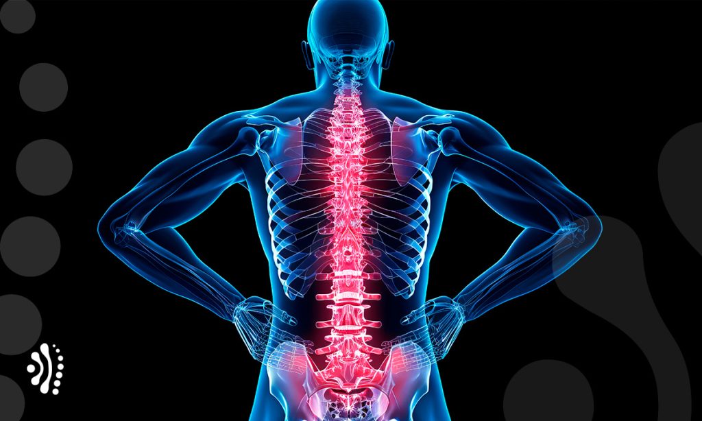 osteofitose bico de papagaio coluna vertebral dr eloy rusafa neurocirurgiao coluna vertebral