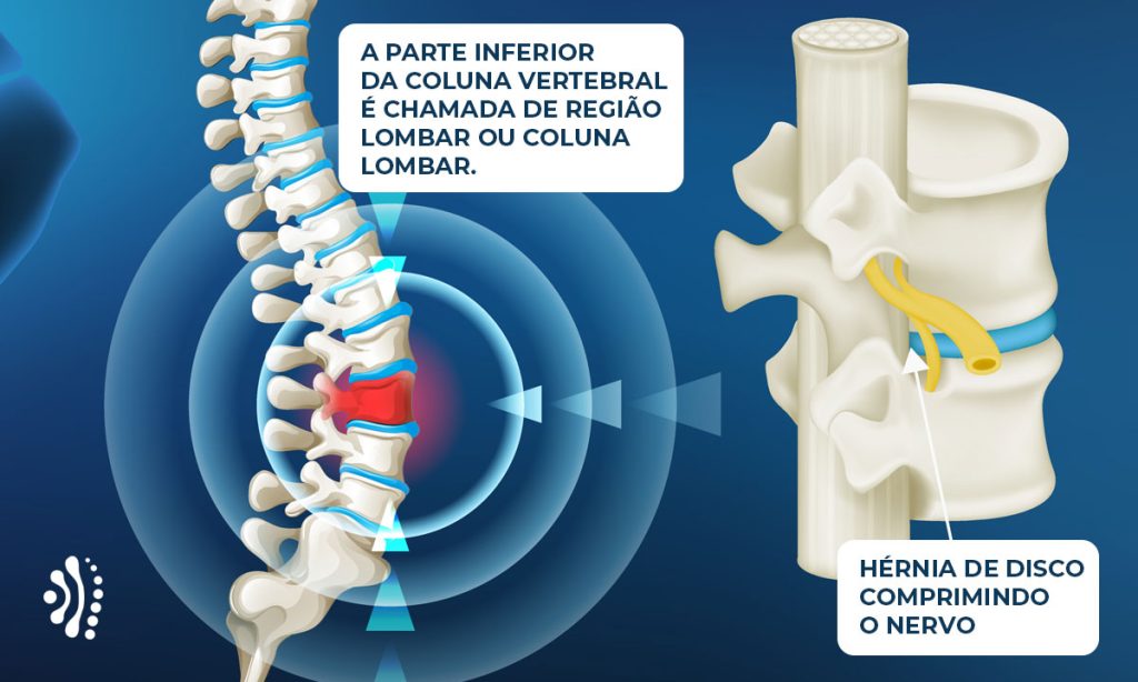ilustracao hernia de disco lombar dr eloy rusafa neurocirurgiao coluna vertebral