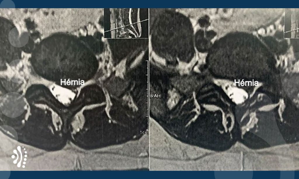 tratamento hernia de disco lombar dr eloy rusafa neurocirurgiao coluna vertebral